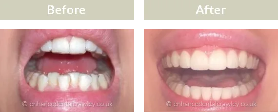 Before and after photographs of a patient smile treated with ClearCorrect aligners