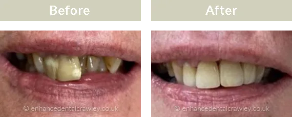 Before and after photographs of a patient smile restored with dental implants, case one