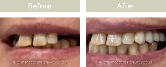Before and after photographs of a patient smile restored with dental implants, case two
