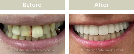 Before and after photographs of a patient smile restored with dental implants, case three