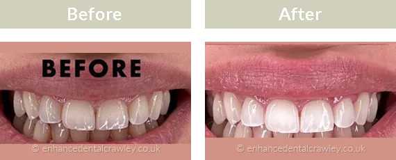 Before and after photographs of a patient smile treated with teeth whitening